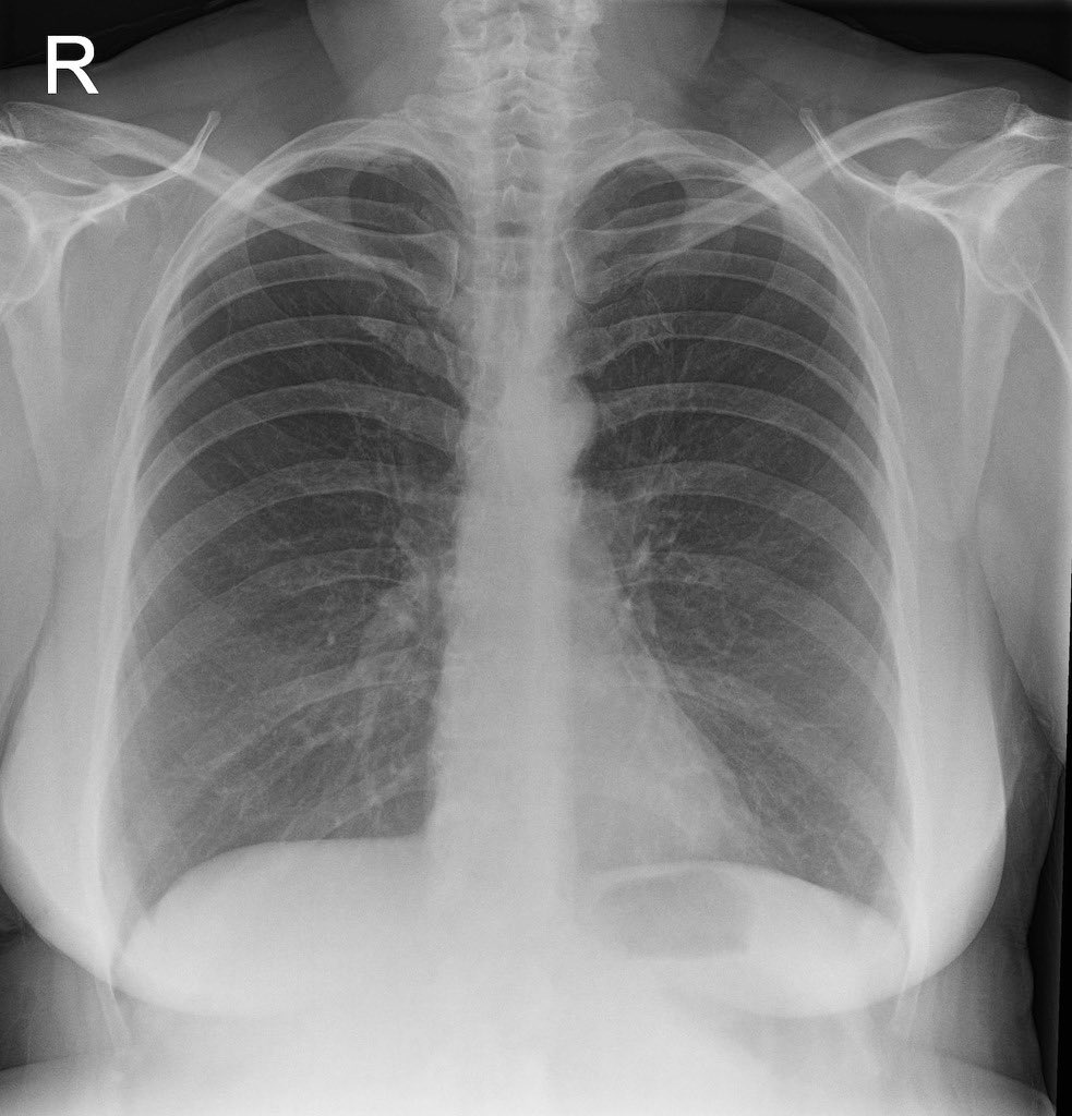 Interesting case

28 year old with history of fever and cough. 

Diagnosis?