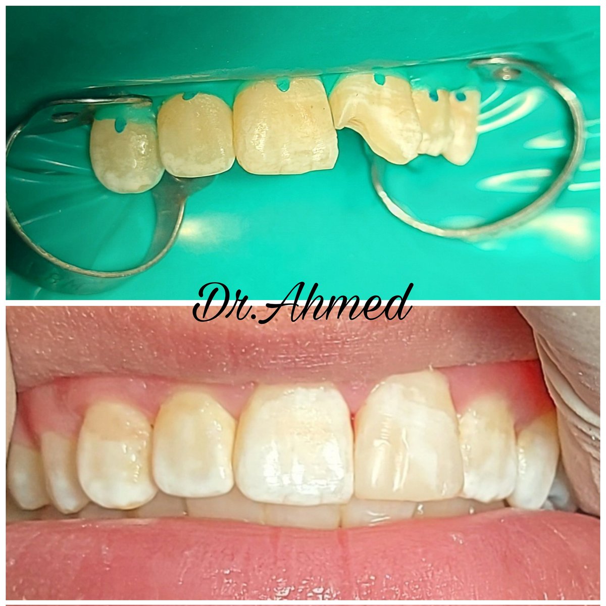A7mee_d_M's tweet photo. روعة الحشوات التجميلية🤍🙏 https://t.co/bcukXEFbfE