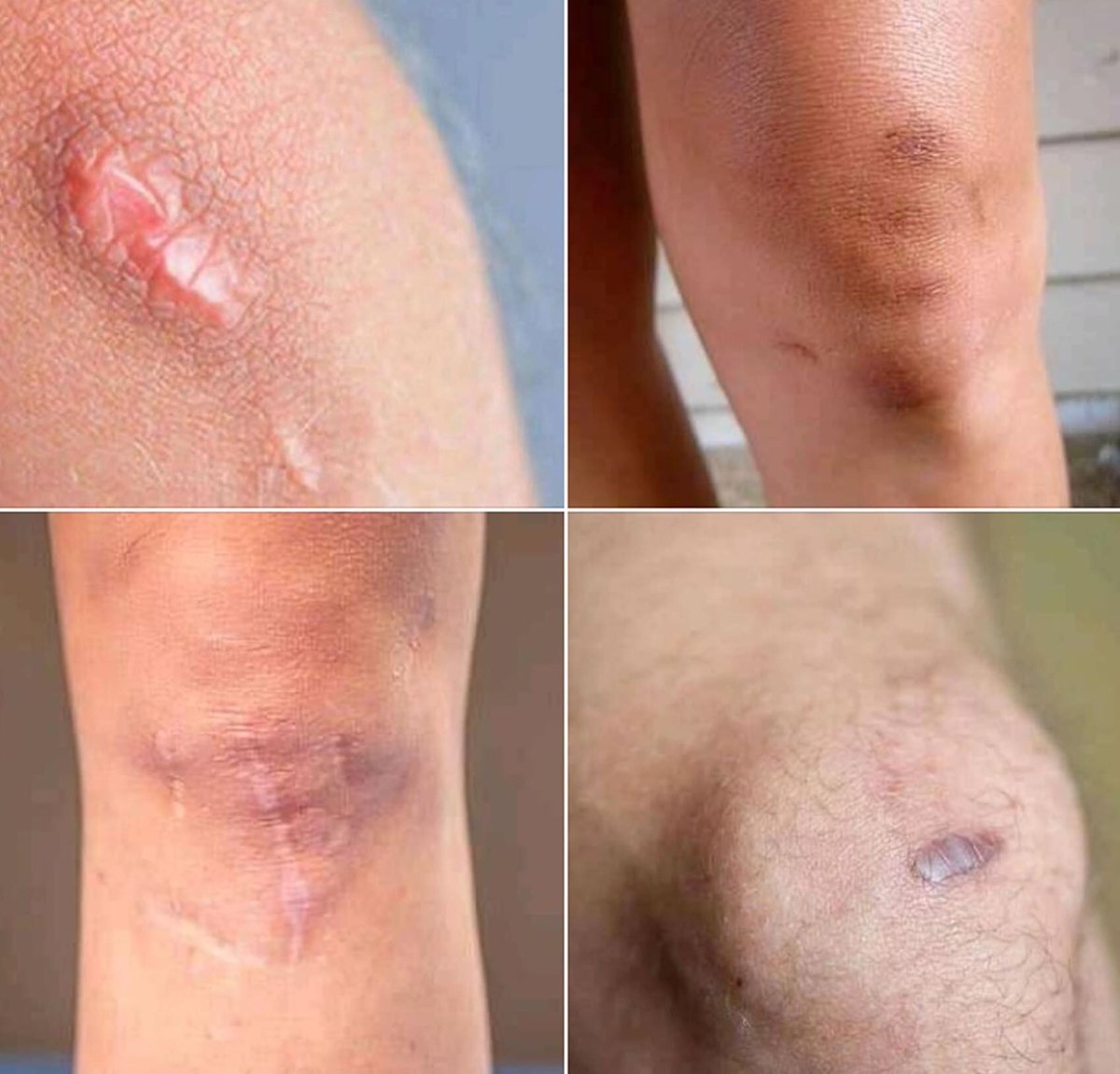 Se você não tem uma dessas na perna sua infância não foi divertida