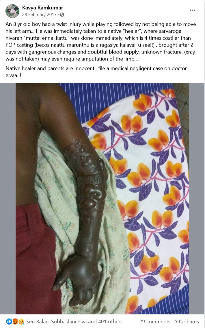 spinesurgeon's tweet photo. What happens with #Native #BoneSetters
#Ischemia
#Gangrene
#SCAM
#Fracture
Modern Scientific Orthopaedics is available, accessible and affordable. Don't go to alternate medicine people and get complications https://t.co/pBs4U2ZKKB