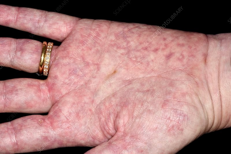 Rising #healthcare expenditure and R&amp;D #vasculitis #treatment and supportive reimbursement policies are the key factors owing to the growth in the segment during forecast period 2020-2025

More info @ 5mp2.short.gy/12la4X
#Biopsy #Magnetic #Angiography