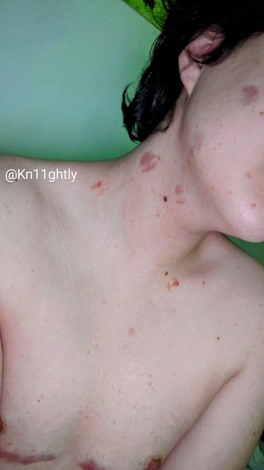 I love it when my bf gives me hickies 🥴 I really cant get enough #hickies #hickie #marking #hot #shirtless<a href="/tag/hot"class="tags"><span>#hot</span></a><a href="/tag/shirtless"class="tags"><span>#shirtless</span></a><a href="/tag/hickies"class="tags"><span>#hickies</span></a><a href="/tag/hickie"class="tags"><span>#hickie</span></a><a href="/tag/marking"class="tags"><span>#marking</span></a>