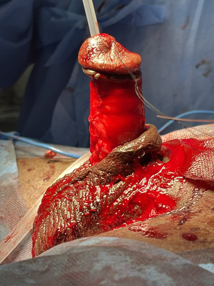 Single stage Chordee correction - BMG corporal patch with pedicled Preputial tube for primary adult severe Hypospadais . Avoid stage repair <a href="/SocietyGURS/">GURS</a> <a href="/brurology_group/">Brazilian Reconstructive Urology Group</a> <a href="/ISORU1/">ISORU</a> <a href="/BAUSurology/">BAUS</a> <a href="/USANZUrology/">USANZ</a> <a href="/ESRUrology/">European Society of Residents in Urology</a>