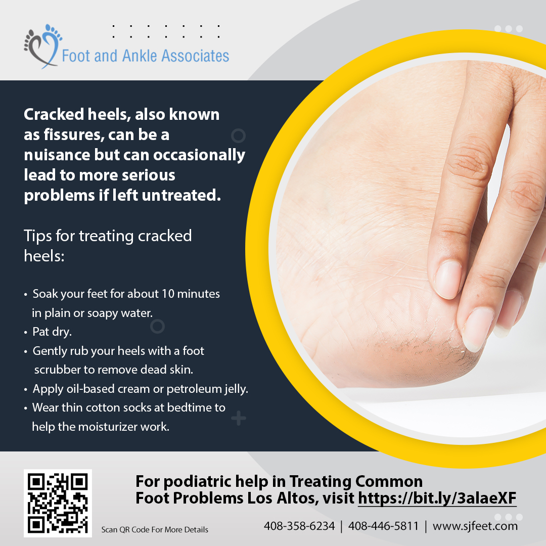 sjfeet's tweet photo. Cracked heels, also known as fissures, can be a nuisance but can occasionally lead to more serious problems if left untreated.
Tips for treating cracked heels:
✅ Soak your feet for about 10 minutes in plain or soapy water.
✅ Pat dry.
#TreatingCommonFootProblemsLosAltos https://t.co/ZNoxsaE9GT