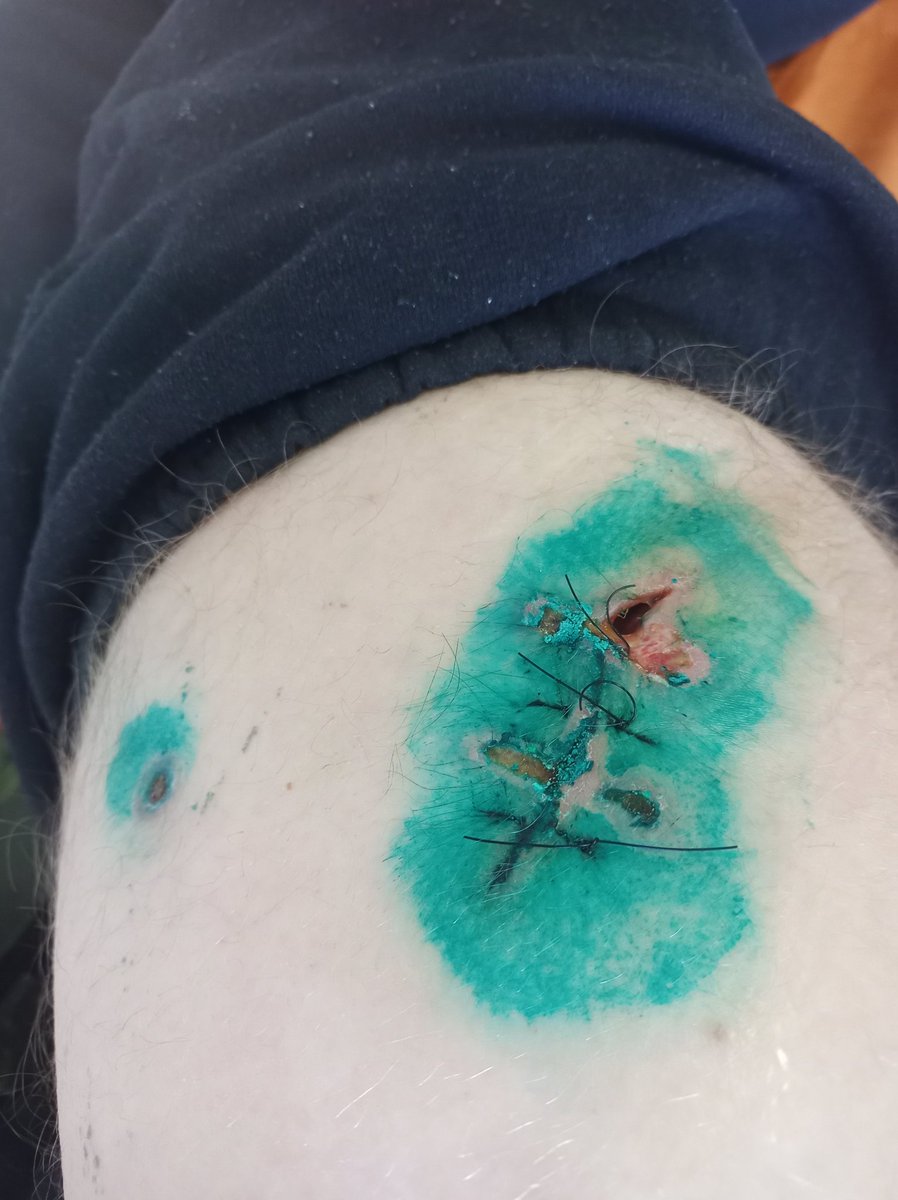 Call_Lassie's tweet photo. Sotaisista vammoista on pikkuhiljaa toivuttu. Ulkomaalaisilla on kiristyssiteen käytössä hiukan opeteltavaa... 
Grad sattuu kun se osuu. https://t.co/h72IrTZTjh