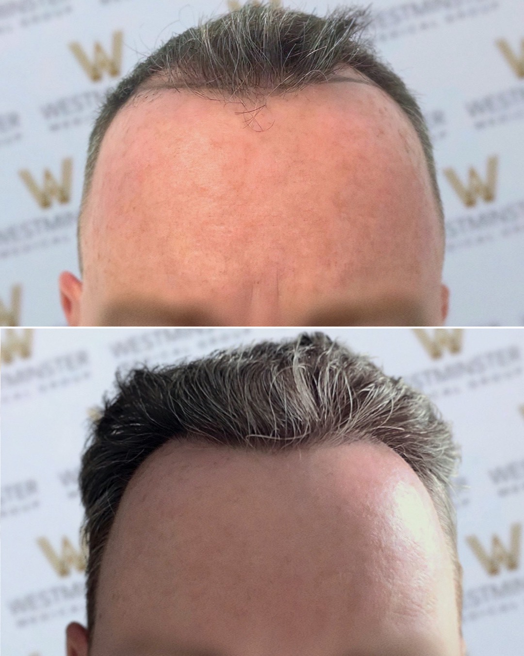 Hairloss Experiences (@Hairtransplant_) / Twitter
