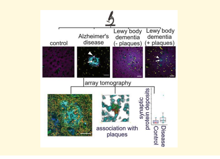 LNDBrainBank's tweet photo. Cysteine string protein-alpha accumulates with early pre-synaptic dysfunction in Alzheimer’s disease.
Keywords: #cysteine #stringproteinalpha; #presynapse; #dystrophy; #amyloidplaque; #AD
https://t.co/g323iKPAnq https://t.co/sJ3CjxeKE9