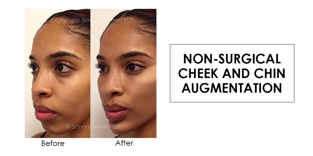 simonourianmd's tweet photo. Non-Surgical Cheek and Chin Augmentation by Dr. Simon Ourian

#simonourian #epione #nonsurgical #facelift #softlift  #nosurgery https://t.co/q0gPkdM3eX