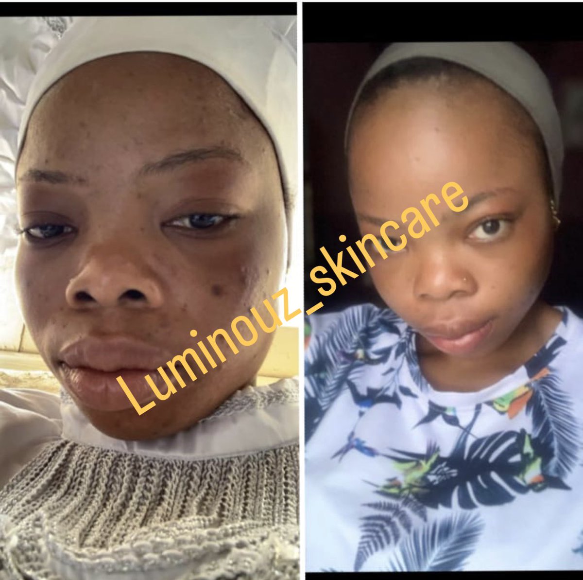 Luminouz_skin's tweet image. It our pimples set 
#skincare 
#pimplestreatment
#facialtreatment 
Contain pimples soap
Pimples cleanser 
Pimples cream
And rose water toner 

Price: #8500

Note: rose water toner contain salicylic acid