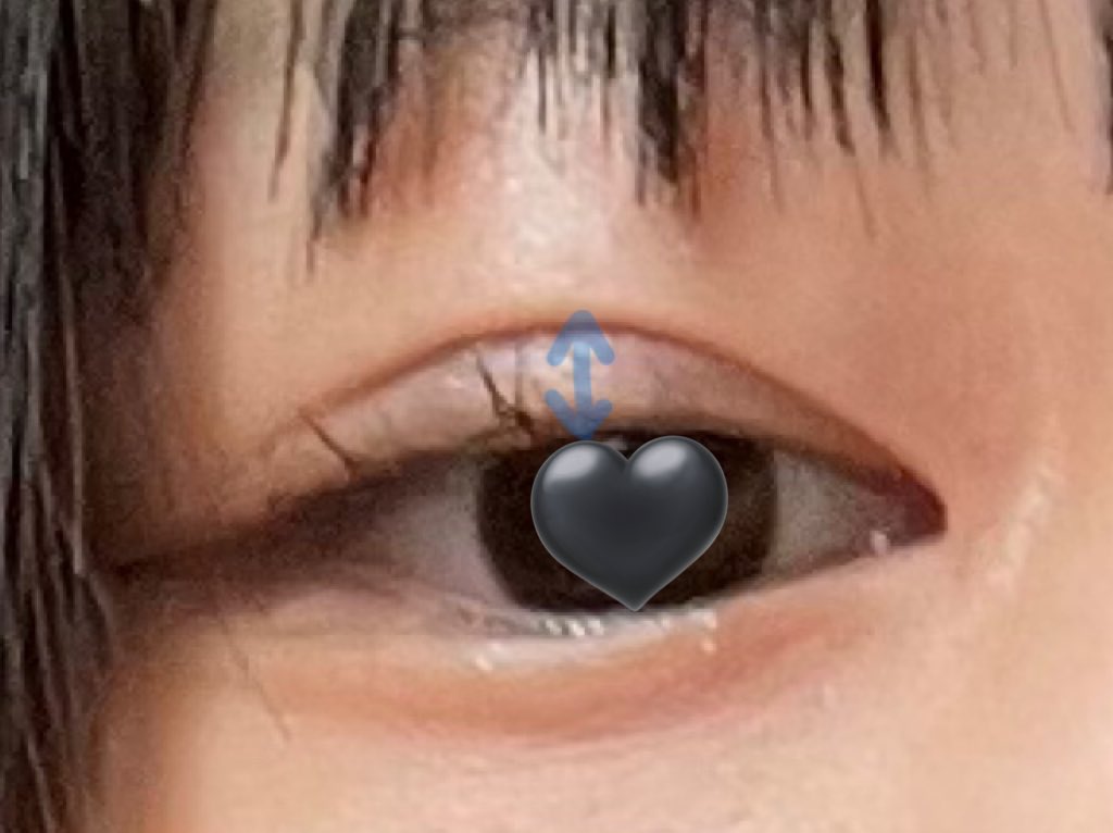 DU9r9's tweet photo. 経過から約1ヶ月の右目(メイク有)です。
個人的に半目状態の形が気になってしまって、今一度、自分の理想の形を考え直してカウンセリングを受けることにしました。

#埋没 #埋没レポ #埋没経過 #埋没dt  #水の森 #水の森美���外科 https://t.co/lLEOVikm9V