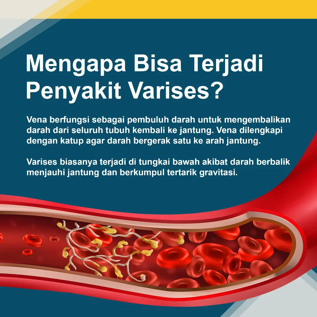 rsbpalangkaraya's tweet photo. Varises
Merupakan salah satu penyakit di tungkai yang banyak diderita.
Apa dan bagaimana penyakit varises itu, simak penjelasanya.
#tahukahkamu #berbagiilmu #dokter #varises #kesehatan #indonesiasehat #infokesehatan https://t.co/leEEeNqshi