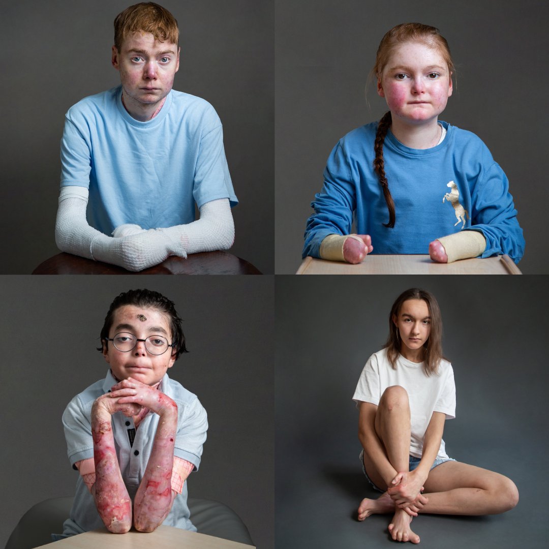 Today we stand in solidarity with the rare disease community on #RareDiseaseDay. 💙

Living with a rare condition, like #EpidermolysisBullosa (EB), means you are more likely to face misdiagnosis, treatment inequality and isolation.

Retweet this post to help us raise awareness.