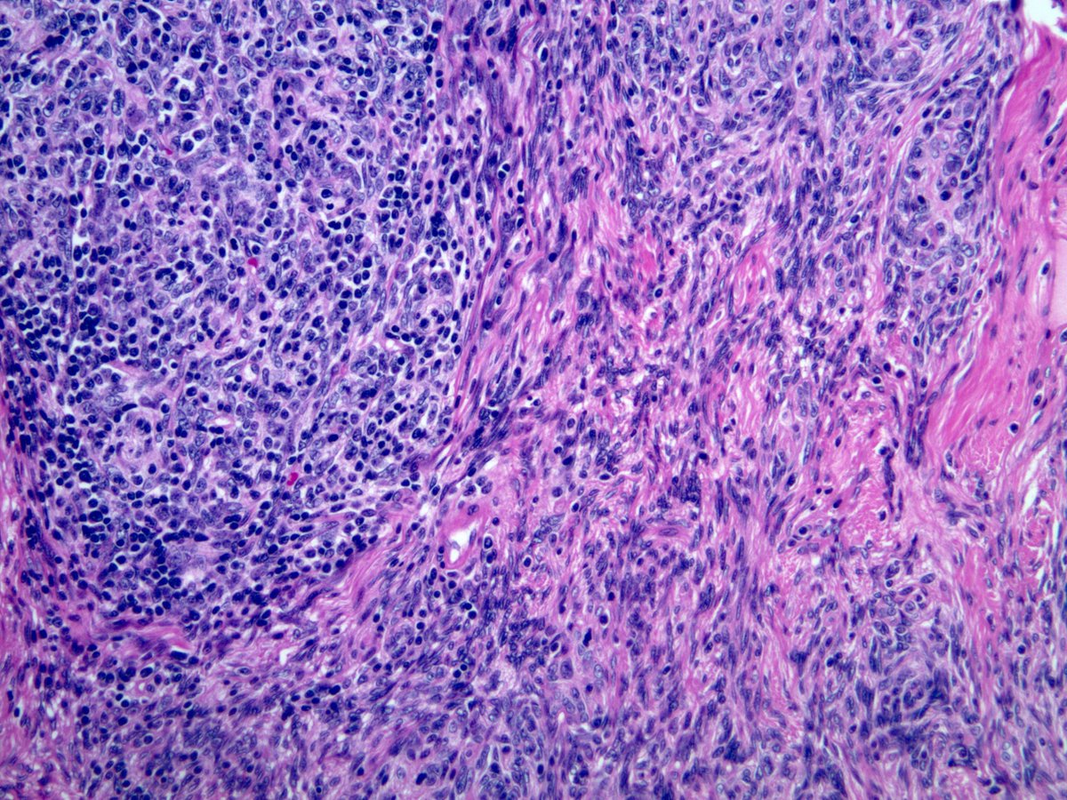 Jerad Gardner, MD on Twitter "RT smlungpathguy Thymoma, type AB