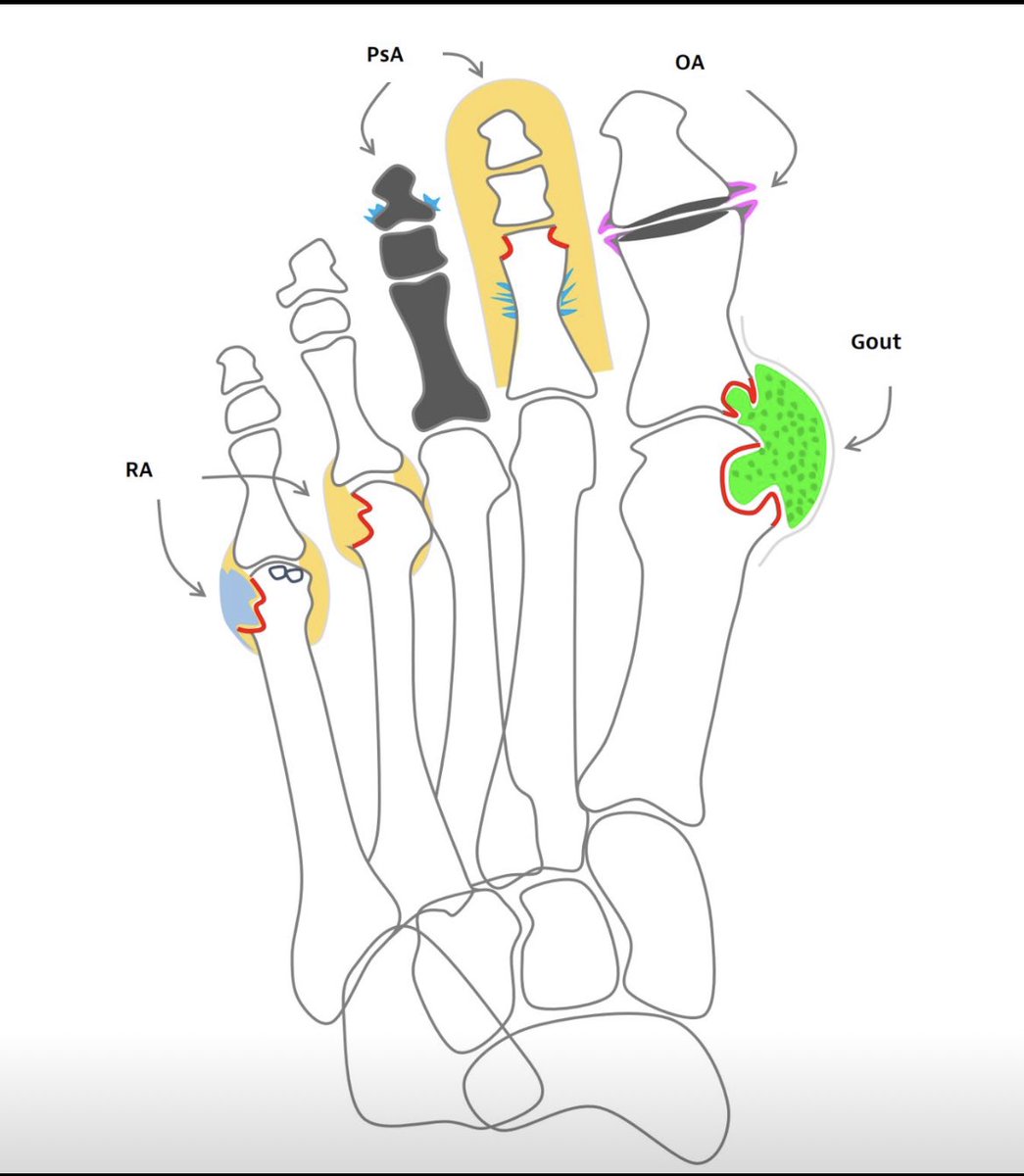 Venkatesh M☯️ (@drvenkimdrd) on Twitter photo Courtesy - Lennart Jans
#msk #FOAMed #FOAMrad #radiology
<a href="/NehaYaduMD/">only_rods_no_cones</a> <a href="/FOAMradOrg/">FOAMrad</a> <a href="/mskteachingroom/">MSK Teaching Room</a> <a href="/ASK_MSK/">Dr. Ameya Kawthalkar</a> Courtesy - Lennart Jans
#msk #FOAMed #FOAMrad #radiology
<a href="/NehaYaduMD/">only_rods_no_cones</a> <a href="/FOAMradOrg/">FOAMrad</a> <a href="/mskteachingroom/">MSK Teaching Room</a> <a href="/ASK_MSK/">Dr. Ameya Kawthalkar</a>