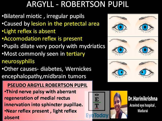 @BrownJHM @Medicalknowled1 @grepmeded Argyll Robertson pupil

small and irregular pupils that have little to no constriction to light but constricts briskly to near targets (light-near dissociation)

Causes : Neurosyphillis
diabetes mellitus, neurosarcoidosis, chronic alcoholism, encephalitis, multiple sclerosis