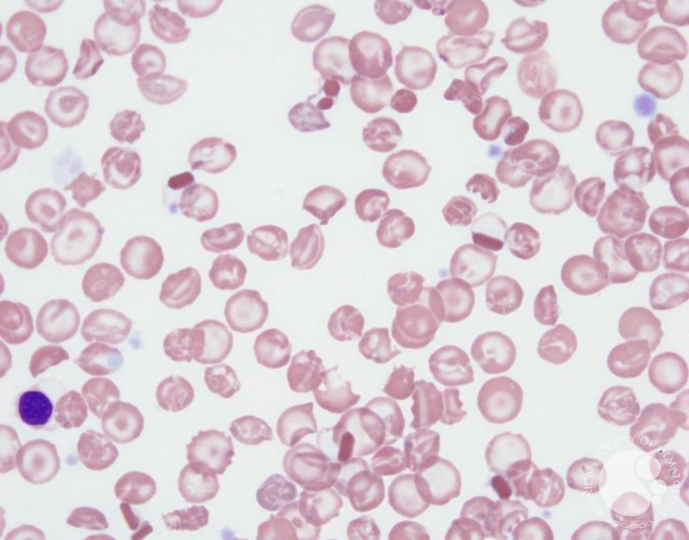 A patient presented for further evaluation of microcytic anemia. A peripheral smear was obtained. What cells are seen & what is the likely diagnosis? H/t @nihardesai7 (Image ASH) #Hemetwitter