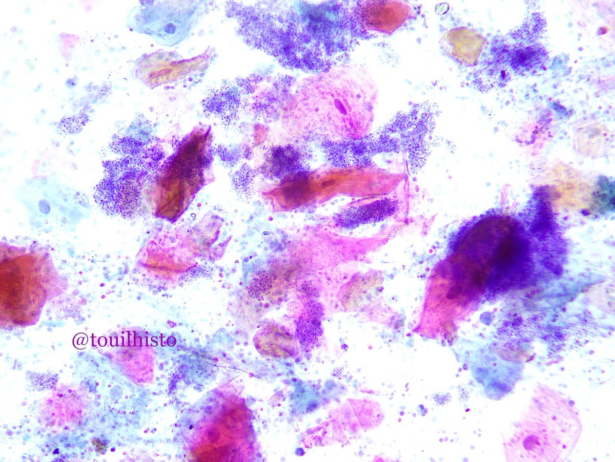 Sperm smear, azoospermia, centrifugation pellet.
Pap stain and the world of colors!