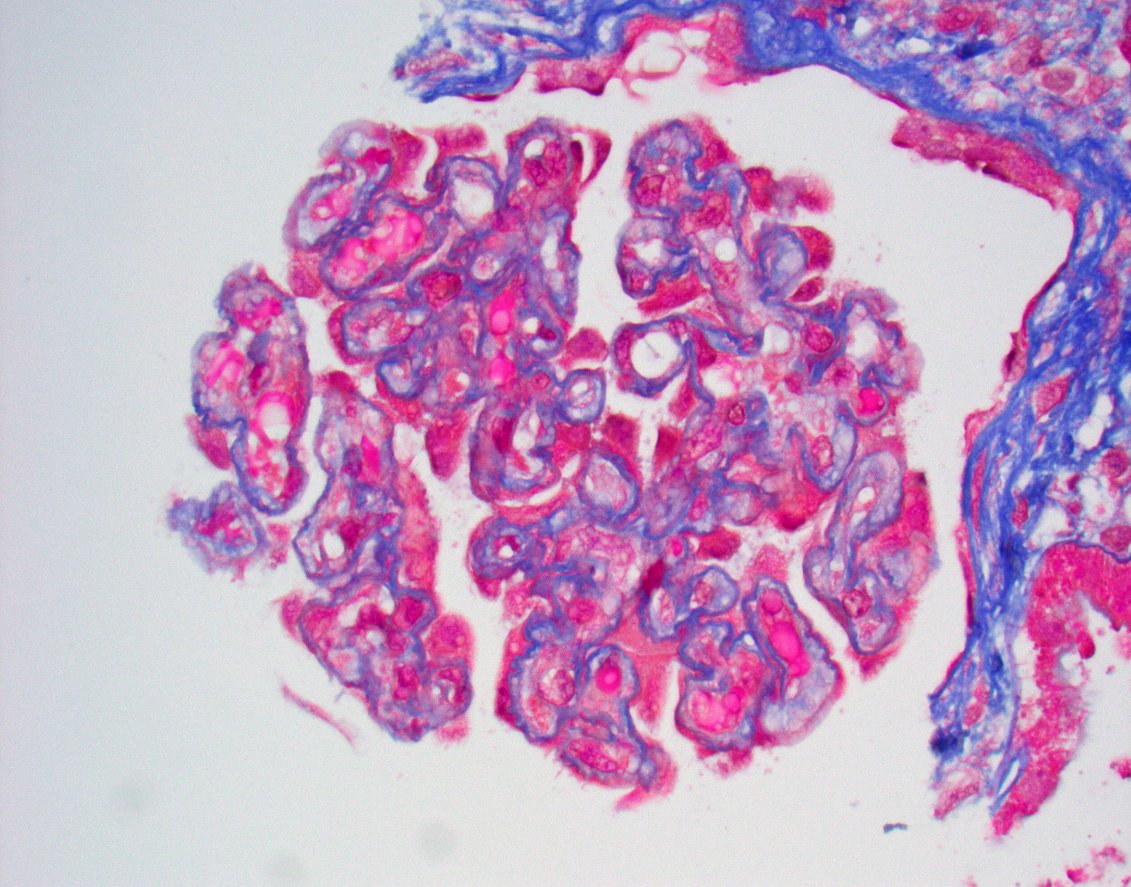 JZRenalPath's tweet photo. Young adult with elevated sCr, proteinuria, and uncontrolled HTN. Biopsy with chronic active microangiopathic injury: arteries with mucoid intimal edema, onion skin change and hyalinosis in arterioles, and focal glomeruli with double contours. #renalpath #pathtwitter https://t.co/4iucyTM5DY