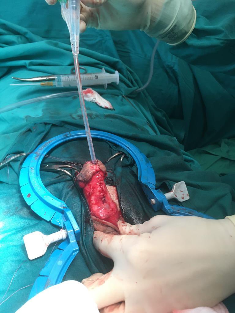 Emiliojemma's tweet photo. Asopa inlay dorsal graft @SaludNorteMalag @UroSoMeSpain @urotoday @urosapiens @docmeetings https://t.co/MieAmMdxce