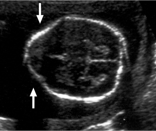 BasicNeurosurge's tweet image. Daily #Neurosurgery Quiz Question 423: 

What is the name of the sign seen in the fetal ultrasound below? Can you name two conditions it is associated with? 

Comment with your answers!
Source: doi.org/10.1148/radiol…