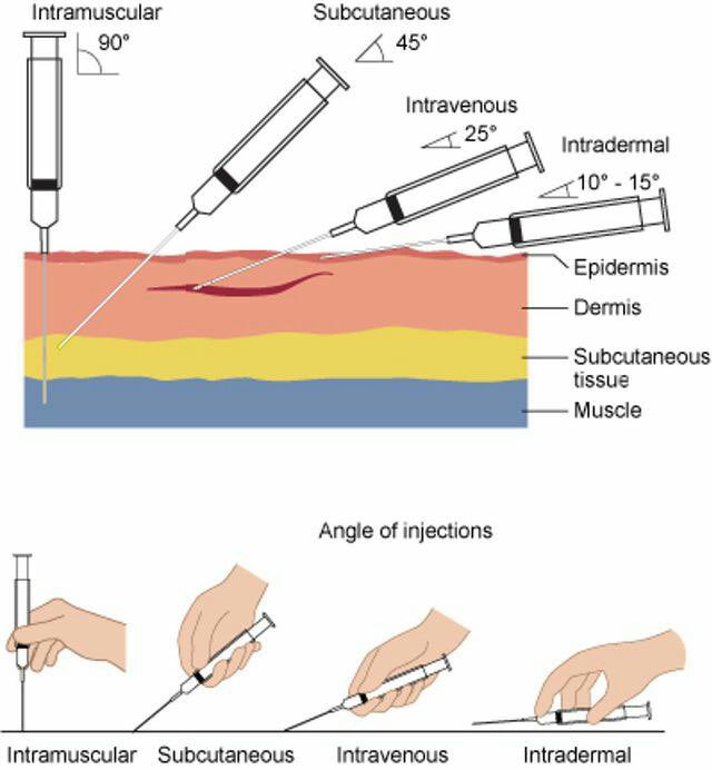 Different types of injection:
- Intramuscular (IM)
- Subcutaneous (SC)
- Intravenous (IV)
- Intradermal (ID)
#MedEd