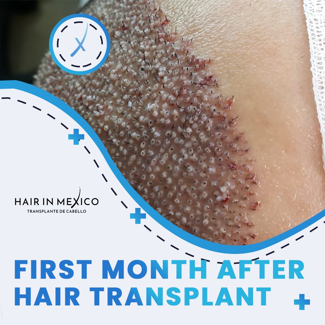 The swelling is expected to go away by the 4th day. You will be given a special shampoo,spray,lotion.These products will be used for the next 10 days.On this period you will start to look better.
#hairtransplantation#hairtransplantationincancun#hairinmexico#clinicinmexico