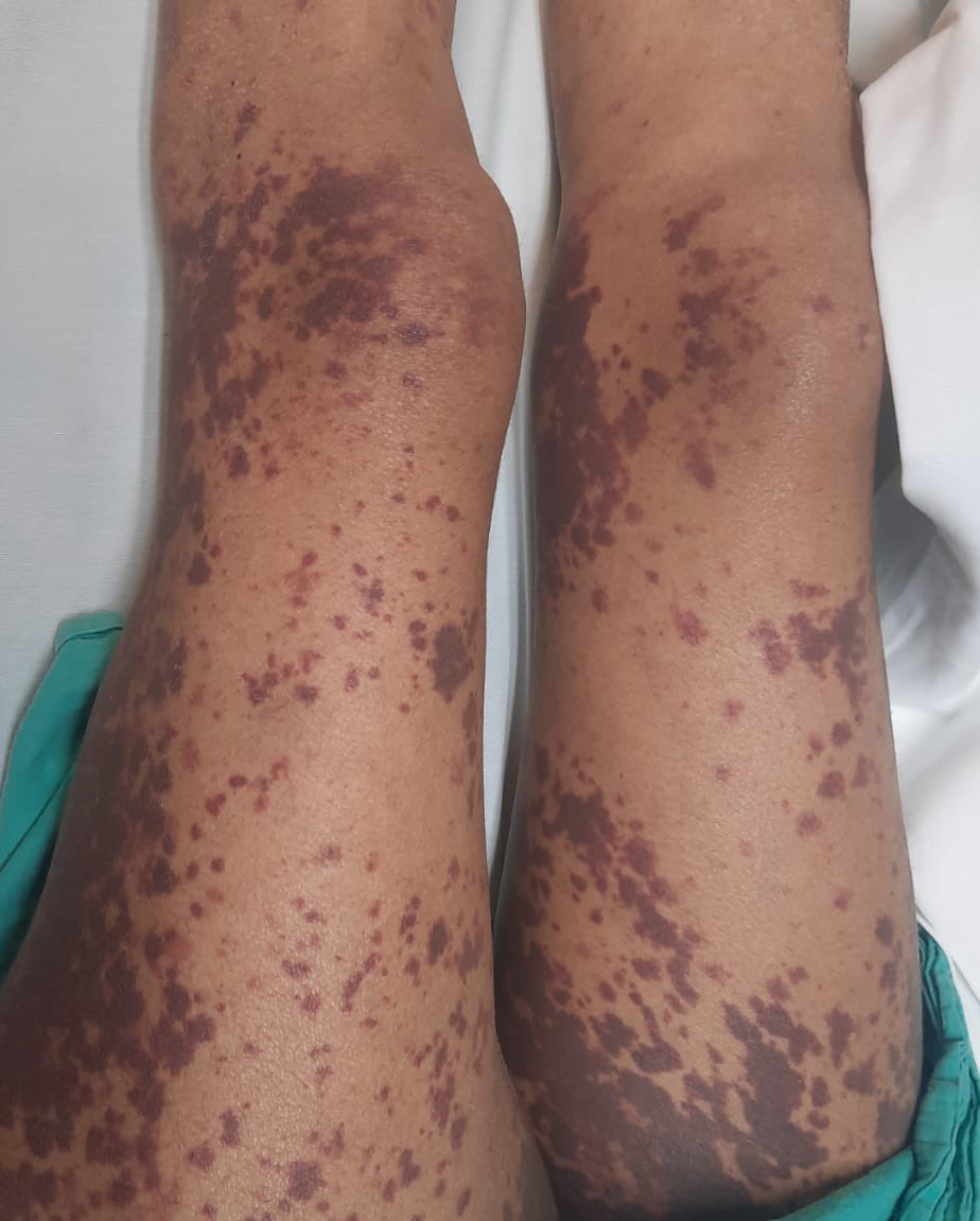Vasculitis 🤨

¿Como y cuando se debe sospechar que nuestro paciente tiene una vasculitis?