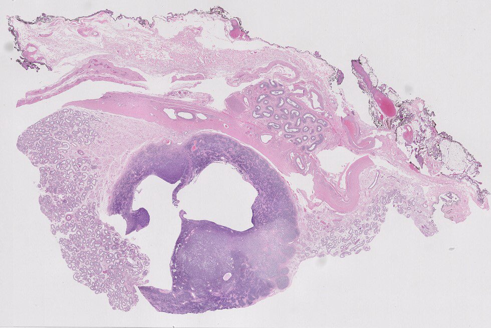 SueEPig's tweet photo. #testistumor 45M/ 2 cm mass 
🔬cytologically bland cells, scant cytoplasm and angulated nuclei showing nuclear grooves, forming sheets, Call-Exner-like bodies with central eosinophilic material, occasional cystic follicle-like structures #gupath #agct 
🎨 inhibin +/ calretinin+ https://t.co/xSmJZMD7Zr