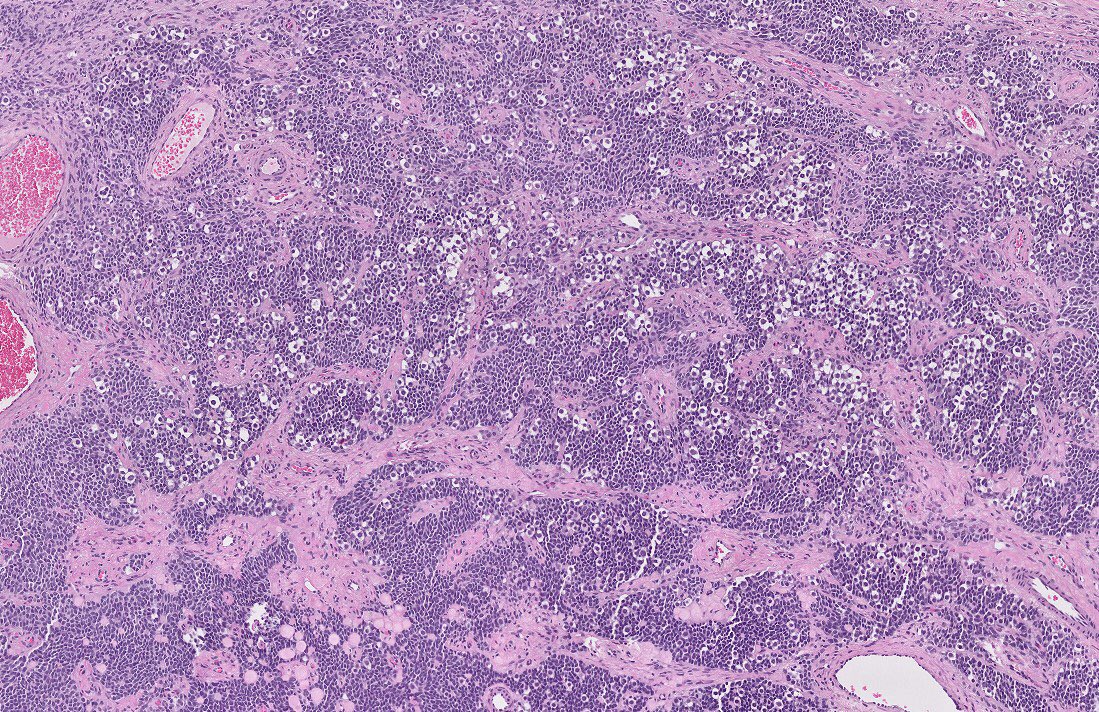 SueEPig's tweet photo. #testistumor 45M/ 2 cm mass 
🔬cytologically bland cells, scant cytoplasm and angulated nuclei showing nuclear grooves, forming sheets, Call-Exner-like bodies with central eosinophilic material, occasional cystic follicle-like structures #gupath #agct 
🎨 inhibin +/ calretinin+ https://t.co/xSmJZMD7Zr