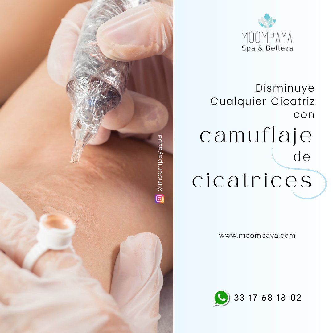 MoompayaSpa's tweet photo. 👏😁¡DISMINUYE LA APARIENCIA DE CICATRICES CON CAMUFLAJE DE CICATRICES #GDL EN CUALQUIER TONO DE PIEL! en Mujeres y Hombres. Sin Dolor!!  VISITA 👉: https://t.co/vW67PTSdmC
Agenda: 33-17-68-18-02
#spagdl  #camuflajecicatricesgdl #cicatricesgdl #camuflajegdl #cicatrices #Miercoles https://t.co/Vs4n7vRLlr