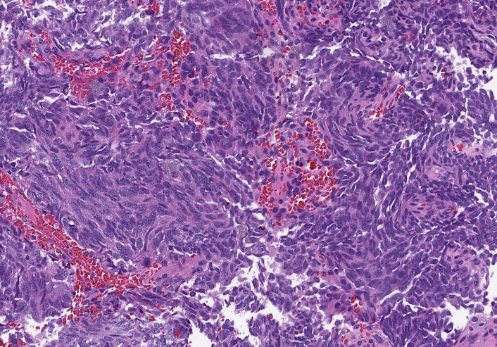 megothelioma's tweet photo. Here's a good one for #pathresidents. This is a lung biopsy. We have roundish-oval nuclei with stippled chromatin, spindled cells in some places. Kind of swirling architecture in this case. What's your diagnosis?
#BasicPath #ThoracicPath #PathTwitter https://t.co/KBmlHntvfr