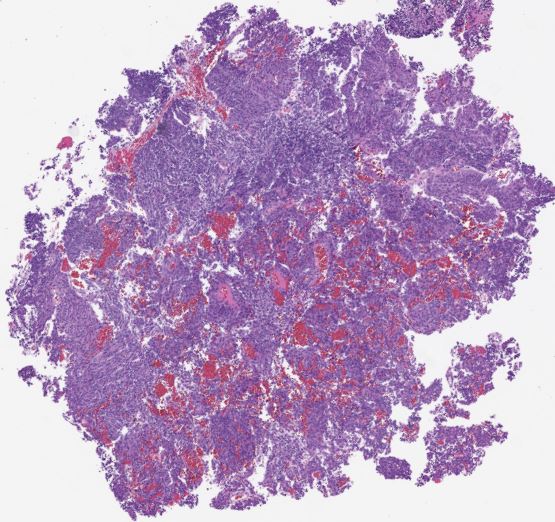 Here's a good one for #pathresidents. This is a lung biopsy. We have roundish-oval nuclei with stippled chromatin, spindled cells in some places. Kind of swirling architecture in this case. What's your diagnosis?

#BasicPath #ThoracicPath #PathTwitter