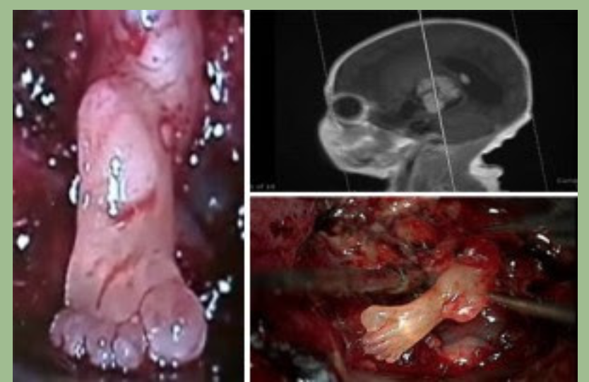The Neurosurgeon noted that this foot quite literally popped out of the brain tumor. "It made me stop operating, since I’m not used to seeing feet in the brain."