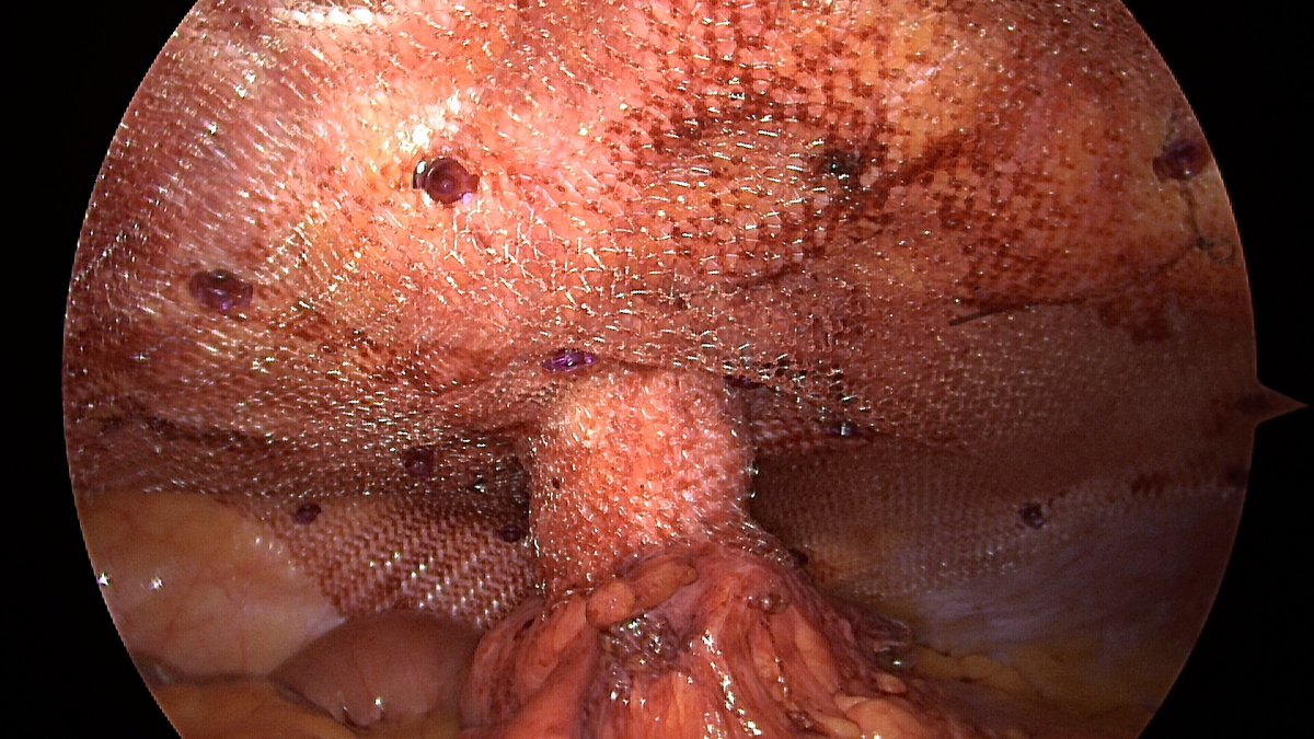 IPST Dynamesh for recurrent parastomal hernia hybrid approach. 
Previous sublay and sutured defect, followed by Sugarbaker repair. 
Likely undiagnosed collagen disorder.
Thank you Prof Dieter Berger, <a href="/Lawmed_Ltd/">Lawmed Ltd</a> <a href="/SpireManchester/">Spire Manchester Hospital</a> 
#hernia #stoma #ileostomy #mesh #keyhole #surgery