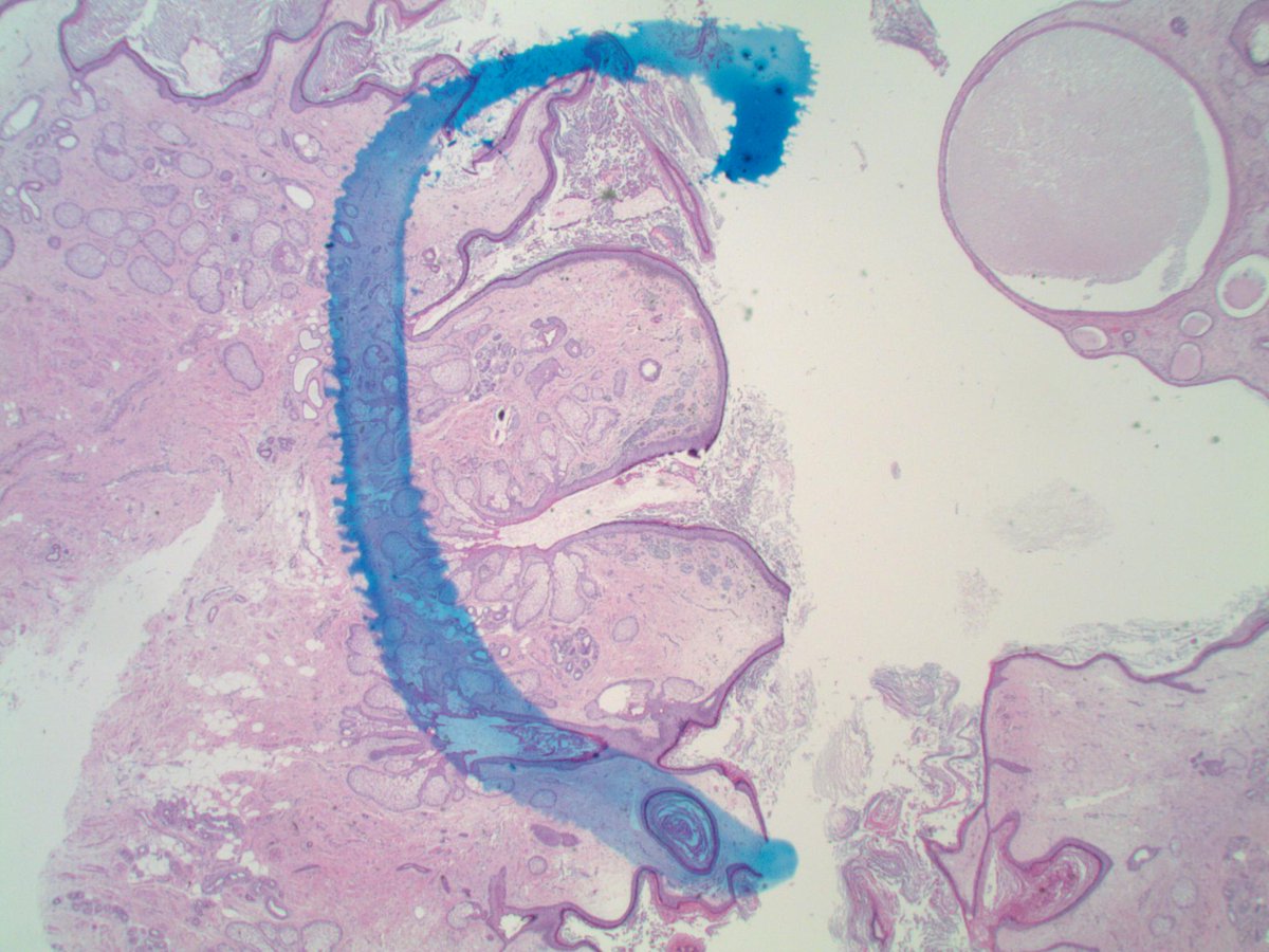 slusagar's tweet photo. here's something you don't 👀everyday...

30ish F, ovarian mass, cystectomy:
mature teratoma with admixed incidental (benign) compound melanocytic nevus

when #dermpath meets #GYNpath 😉 https://t.co/KtqYjA5zra