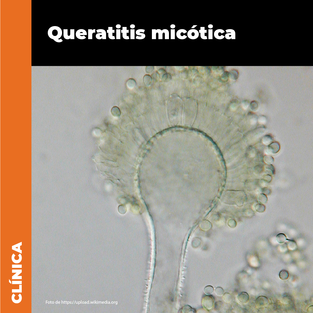 FranjaVisual's tweet photo. Al avanzar la ciencia diagnóstica de la queratitis micótica,se establecerán mejores procesos de prevención y tratamiento oportuno de la enfermedad, evitando consecuencias graves en la visión de los pacientes.
#franjavisual #lentes #visión #somoscomunidadsaludvisual #americalatina https://t.co/it71rnGYfH