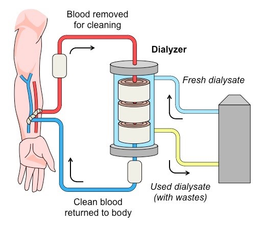 Nephrology19's tweet photo. #Nephrology journal includes wide areas of studies in this field by including #dialysis #kidneyTransplant #acutekidney failure #chronickidney disease, #cancer-related kidney diseases etc. https://t.co/TdCMx7NJfv.
Submit your manuscript at: https://t.co/iS9hdtA3Gz https://t.co/OQJvBcMOOp