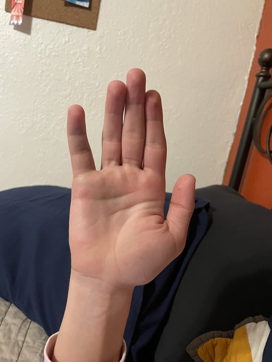 Well my #Hearties nurses. here’s your finger update. Orthopedic appointment in the a.m. and now that swelling gone down no question it broke. X-ray shows main break near the knuckle but the tip isn’t lookin too good either. PS ur boy got a 99 on his drive test 💪🏼
