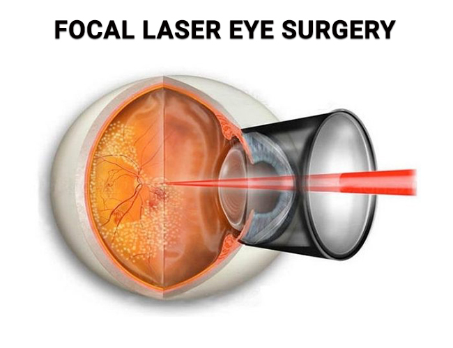 Laser photocoagulation is a type of laser surgery for the eyes. It is done to treat age-related macular degeneration (AMD). It is a condition that can lead to loss of vision.
#laser #photocoagulation #lasersurgery #AMD #ophthalmology