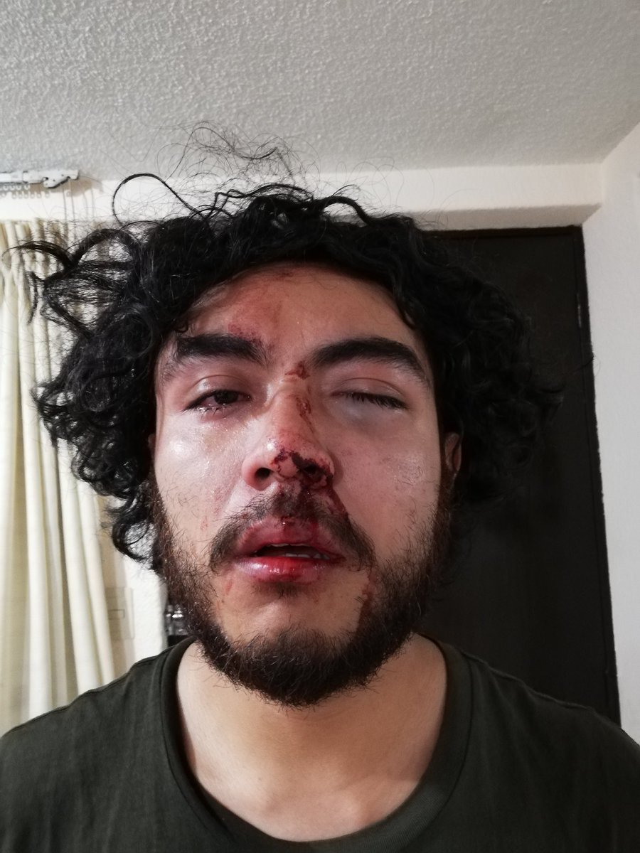 Protista_Prieto's tweet photo. Hola. Quiero compartir una lamentable situación que viví en el antro @cabaretito Punto y aparte.
El pasado 19/febrero un grupo de personas le robaron el teléfono a mi novio, nos violentaron al grupo con quien venía y me golpearon generándome múltiples fracturas en mi cara. https://t.co/mquZMIU8Rp