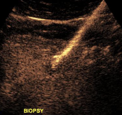 Malak Itani (@itanimalak) on Twitter photo If you're attending #SAR23 and want to start or learn more about CEUS in procedures, attend workshop #144 at 2pm in Violet "Logistics and Utility of Contrast Enhanced Ultrasound in Procedures".. Thrilled to co-present with <a href="/RachitaKhot/">Rachita Khot</a> If you're attending #SAR23 and want to start or learn more about CEUS in procedures, attend workshop #144 at 2pm in Violet "Logistics and Utility of Contrast Enhanced Ultrasound in Procedures".. Thrilled to co-present with <a href="/RachitaKhot/">Rachita Khot</a>