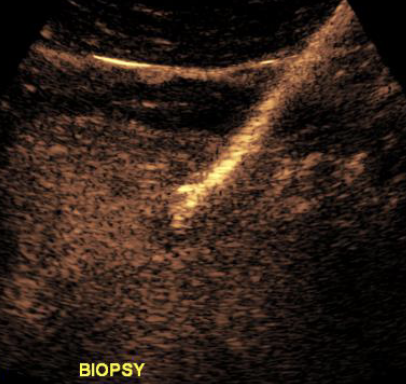 If you're attending #SAR23 and want to start or learn more about CEUS in procedures, attend workshop #144 at 2pm in Violet 'Logistics and Utility of Contrast Enhanced Ultrasound in Procedures'.. Thrilled to co-present with @RachitaKhot