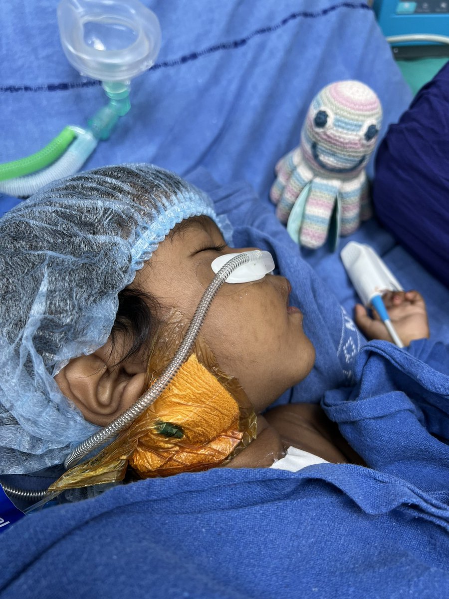 DrRamanaCardiac's tweet photo. Day 4: Healing Little Hearts❤️‍🩹Liv’sLegacy🐙camp 2, Hyderabad,India.2 open heart surgeries today. Newborn baby with complex problems and a long operation, was very sick and needed ECMO support. Finished at 4:30 AM but good to see the other case from today ready to leave the PICU. https://t.co/FSAqF4TXAU