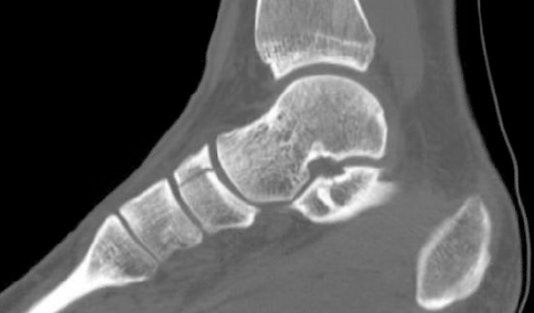 Flawless_Physio's tweet photo. Athletes can have the symptoms of a Navicular Stress Fracture (NSF) for on average of 9 months before they receive the correct diagnosis. 

Let's look at some of the reasons why this may be. 1/8 🧵

Image: https://t.co/1vYM7gIKAI https://t.co/XlrVzbrlbC