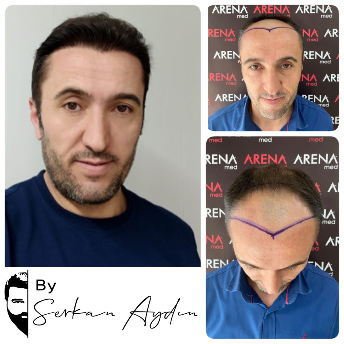 Arenamedd's tweet photo. #serkanaydin #arenamed #saçlıseferleri #hayallerdökülmez #srk #hayallerdökülmezsrk #hayallerdökülmezserkanaydın
#saçaatılanimzaserkanaydın #thesignatureonhairserkanaydın #saçaatılanimza #thesignatureonhair #srkline 🧿👍 https://t.co/pFZ1ZEHPI2