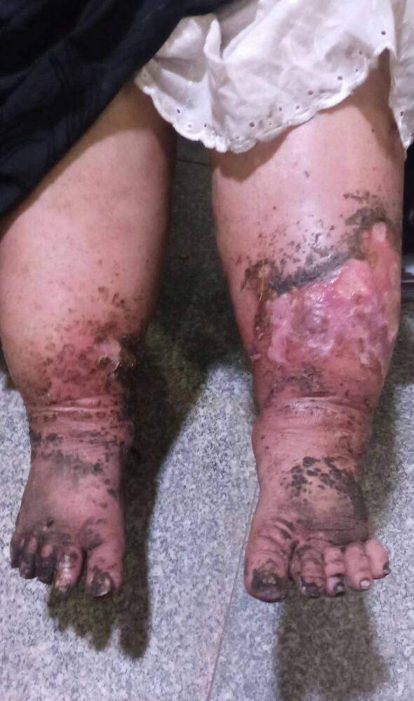 45yo diabetic female presented with painful red swelling followed by large ulcers over the left leg for 2 weeks.H/O intermittent claudication.The left leg pulse is not felt in the popliteal fossa.What is the probable diagnosis?
#MedTwitter #vascular #dermatology #medicalstudents
