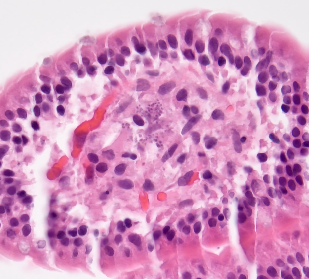 MdSuster's tweet photo. What a case!!
Patient presents with abdominal discomfort; whats the diagnosis?
#pathtwitter #GIpath #surgpath #pathology #clinpath #bugs https://t.co/cabQAJBVxK
