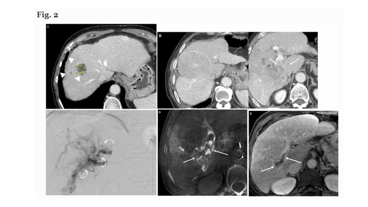 Hot off the press <a href="/CVIR_Journal/">CVIR Journal</a>, <a href="/ucsd_ir/">UC San Diego Interventional Radiology</a> showing that rad seg/rad lobectomy after TACE with refractory disease is safe and effective with a response rate of 85%. In this example, a CR on TACE -&gt; TIV -&gt; TARE. <a href="/shawn2d2/">Shanmukha Srinivas</a>  <a href="/bsc_io/">Peter Pattison</a> <a href="/SIRspecialists/">Society of Interventional Radiology</a> <a href="/SIO_Central/">SIO</a>