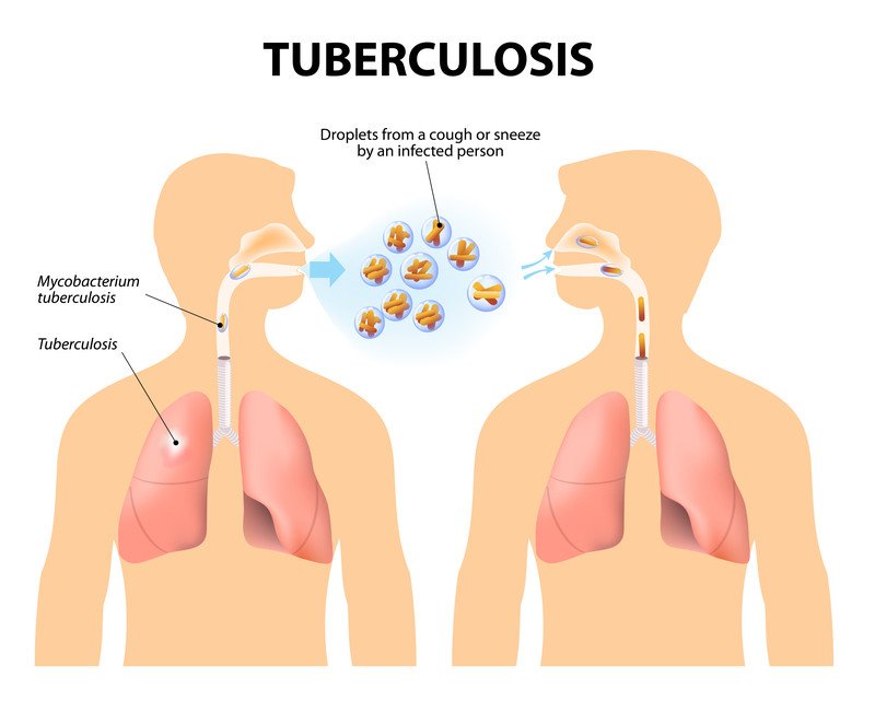 StopTBKe's tweet photo. Drug-resistant TB occurs when bacteria become resistant to the drugs used to treat TB. This means that the drug can no longer kill the TB bacteria. Drug-resistant TB (DR TB) is spread the same way that drug-susceptible TB is spread. https://t.co/Xwe8bz8oOD