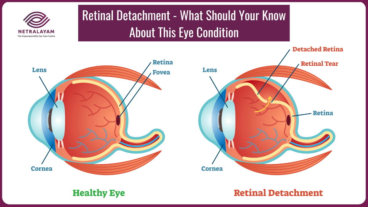 Have you ever experienced an abrupt rise in floaters in your sight, unexpected onset of neon lights or flashes, or a drape or curtain occasionally darkening your vision? These could be signs of retinal detachment. Read more:
ow.ly/bwEO50N5JB6
#RetinalDetachment #EyeFloaters